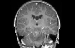 Coronal t1ce slice